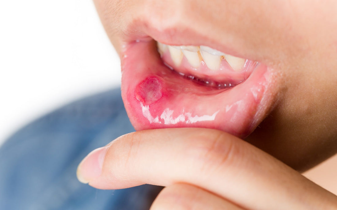 Mouth ulcer on inner bottom lip